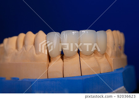 Frames of ceramic crowns on a gypsum model. Zirconia crowns. Metal-free ceramics at the manufacturing stage. Close-up, black isolate. Frames of ceramic crowns on a gypsum model. Zirconia crowns. Metal-free ceramics at the manufacturing stage. Close-up, black isolate. 92036623