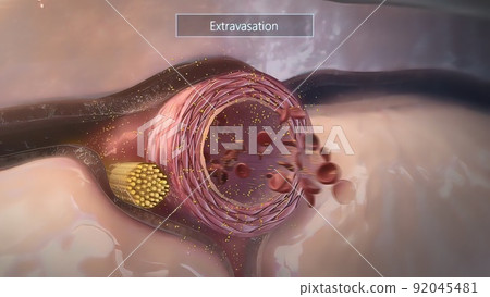 Extravasation, leakage of vesicant fluids or... - Stock Illustration ...