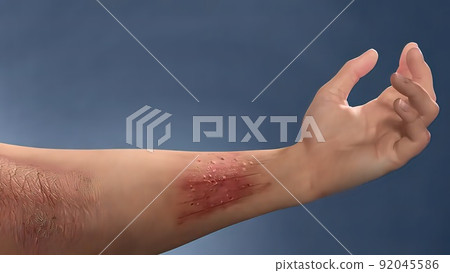 Skin sore, itching and scar 92045586