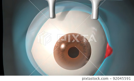 Cataract surgery application view Surgical operations on the human eye Cataract surgery application view Surgical operations on the human eye 92045591