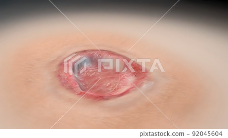 Crust and dressing following a burn or cauterization of the skin 92045604