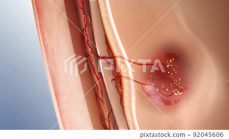 Glaucoma eye disease 3D illustration medical 92045606