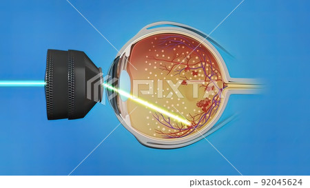 Laser surgery , eye laser treatment Laser surgery , eye laser treatment 92045624