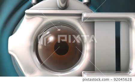 Cataract surgery application view Surgical operations on the human eye 92045628