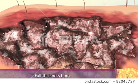 Illustration Of Burn Depth