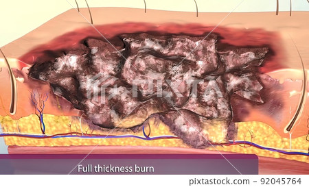 Full thickness burns are third degree burns. 92045764