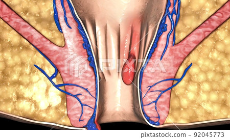A first degree internal hemorrhoid bulges into the anal canal during bowel movements. 92045773