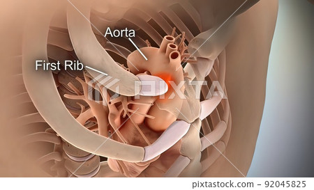 medical skeleton rib fracture medical skeleton rib fracture 92045825
