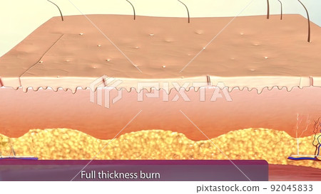 Full thickness burns are third degree burns. 92045833