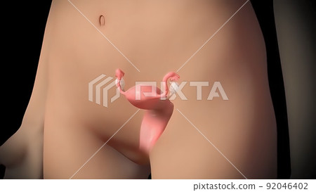 Uterus with endometriosis . Fertility, human anatomy, female reproductive system. 92046402