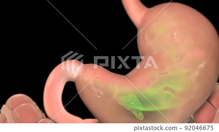 This shows the gastroesophageal reflux 92046675