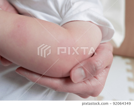 Image of insect bites and bruises on children's arms Image of insect bites and bruises on children's arms 92064349