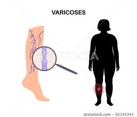 Varicose veins treatment Varicose veins treatment 92145341