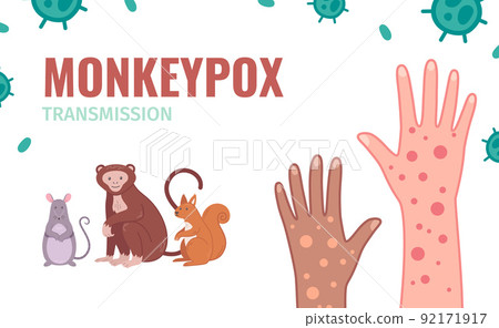 Monkeypox Virus Infographics 92171917