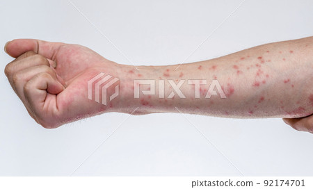 被毛毛蟲咬後漲紅的手臂 92174701