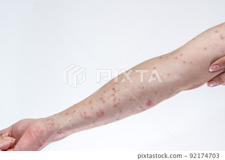 被毛毛蟲咬後漲紅的手臂 92174703