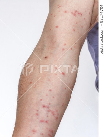 被毛毛蟲咬後漲紅的手臂 92174704