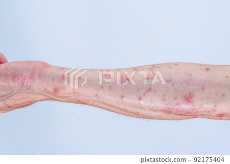 Arm up that swells red after being bitten by a caterpillar Arm up that swells red after being bitten by a caterpillar 92175404