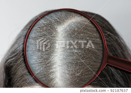 Close-up of the parting of brunette hair on the head covered with dandruff. View through magnified glass. The concept of seborrheic dermatitis 92187637
