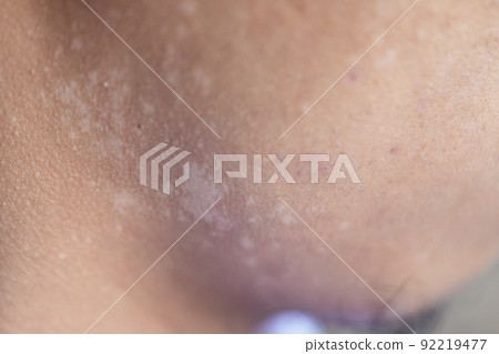 Pattern of Atopic eczema and fungal diseases on the human body. Pattern of Atopic eczema and fungal diseases on the human body. 92219477