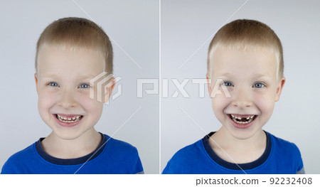 Before and after. Falling out milk tooth. Blond boy in photo has a loose milk tooth, and in other image it has already fallen out. An empty space in place of front teeth. Loss of milk teeth 92232408