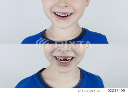 Before and after. Falling out milk tooth. Blond boy in photo has a loose milk tooth, and in other image it has already fallen out. An empty space in place of front teeth. Loss of milk teeth Before and after. Falling out milk tooth. Blond boy in photo has a loose milk tooth, and in other image it has already fallen out. An empty space in place of front teeth. Loss of milk teeth 92232409