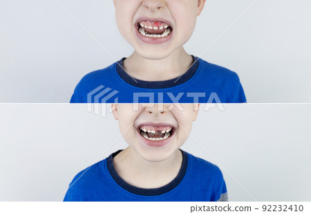 Before and after. Falling out milk tooth. Blond boy in photo has a loose milk tooth, and in other image it has already fallen out. An empty space in place of front teeth. Loss of milk teeth 92232410
