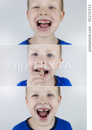 Before and after. Falling out milk tooth. Blond boy in photo has a loose milk tooth, and in other image it has already fallen out. An empty space in place of front teeth. Loss of milk teeth Before and after. Falling out milk tooth. Blond boy in photo has a loose milk tooth, and in other image it has already fallen out. An empty space in place of front teeth. Loss of milk teeth 92232412