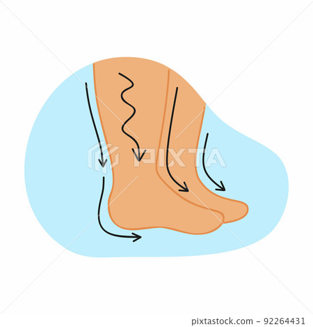 Human feet and leg swelling. Vector illustration on the topic of medicine. Human feet and leg swelling. Vector illustration on the topic of medicine. 92264431