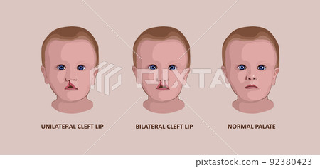 Cleft palate in a child. Reconstruction of the... - Stock Illustration ...