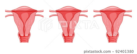 Set of Cervical cancer Dysplasia stages infographic Female reproductive system Carcinoma uterus. Front view in a cut 92401380