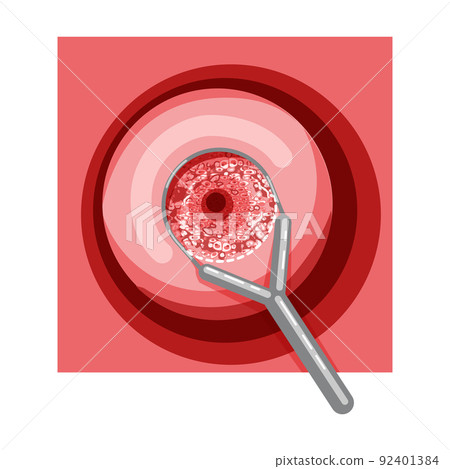 Electrocoagulation diathermy of the cervical dysplasia cancer infographic Female reproductive system Carcinoma uterus Electrocoagulation diathermy of the cervical dysplasia cancer infographic Female reproductive system Carcinoma uterus 92401384