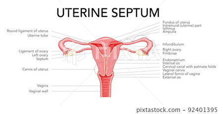 Uterine septum septate uterus Female reproductive system diagram with inscriptions text. Front view in a cut. Human Uterine septum septate uterus Female reproductive system diagram with inscriptions text. Front view in a cut. Human 92401395
