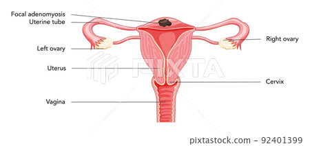 Focal Adenomyosis with inscriptions, Human anatomy Female reproductive Sick system organs. Structure of uterus, cervix Focal Adenomyosis with inscriptions, Human anatomy Female reproductive Sick system organs. Structure of uterus, cervix 92401399