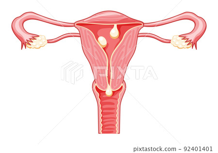 Polyps in the uterus - cervical, pedunculated and sessile Female reproductive system in cross sections. Front view 92401401