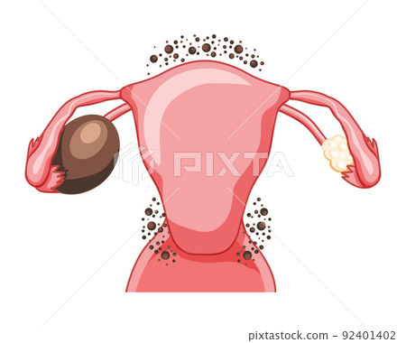 Ovarian endometriomas chocolate cysts Female reproductive system uterus problem. Human medical anatomy internal organs Ovarian endometriomas chocolate cysts Female reproductive system uterus problem. Human medical anatomy internal organs 92401402
