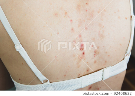Side view of acne sequelae, torn pimples, skin itching on the back. Side view of acne sequelae, torn pimples, skin itching on the back. 92408622