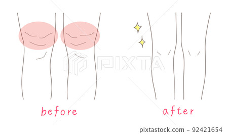 腿粗的女人和腿細的女人的插圖素材 腿粗的女人和腿細的女人的插圖素材 92421654