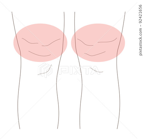 一個腿粗的女人的插圖素材 一個腿粗的女人的插圖素材 92421656