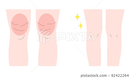 Illustration material of a woman with thick legs and a woman with thin legs Illustration material of a woman with thick legs and a woman with thin legs 92422264