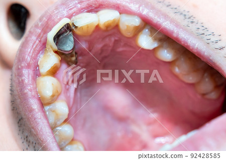Photograph of root canal caries. A photo of a tooth with an exposed root. Terrible tooth decay. 92428585