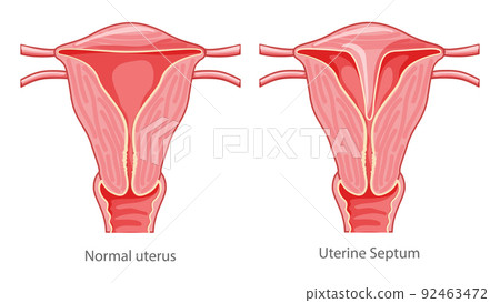 Set of Uterine septum septate uterus Female reproductive system diagram normal and with disease pain. Front view in cut 92463472