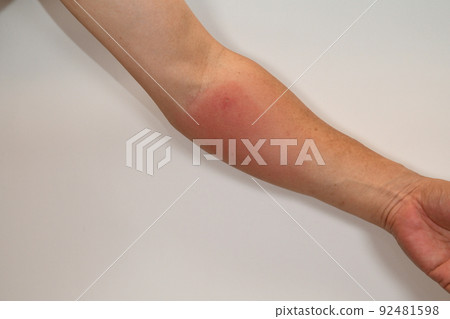 A man's arm swollen red the day after being bitten by a paper wasp A man's arm swollen red the day after being bitten by a paper wasp 92481598