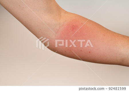男子被紙黃蜂咬後第二天手臂紅腫 男子被紙黃蜂咬後第二天手臂紅腫 92481599