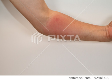 男子被紙黃蜂咬後第二天手臂紅腫 92481600