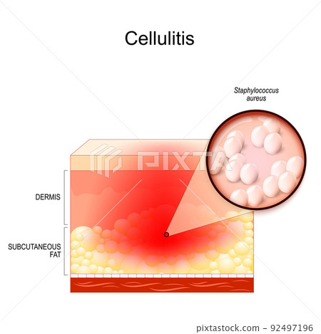cellulitis. Cross section of layers of the human Skin with symptoms of Infectious disease cellulitis. Cross section of layers of the human Skin with symptoms of Infectious disease 92497196