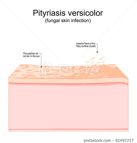 Pityriasis versicolor. fungal skin infection. Cross section of a human skin Pityriasis versicolor. fungal skin infection. Cross section of a human skin 92497257