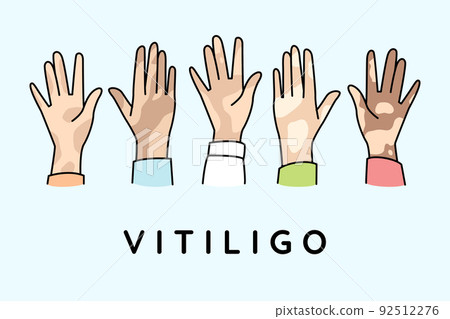 People hands with vitiligo People hands with vitiligo 92512276