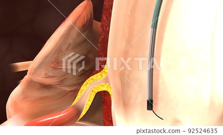 coronary angiography procedures 3d 92524635