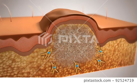 healing of the wound on the skin 92524719